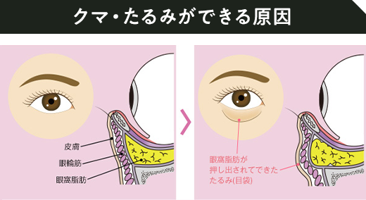 クマ・たるみができる原因