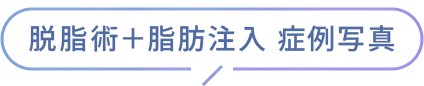 脱脂術＋脂肪注入 症例写真