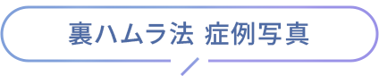 裏ハムラ法 症例写真