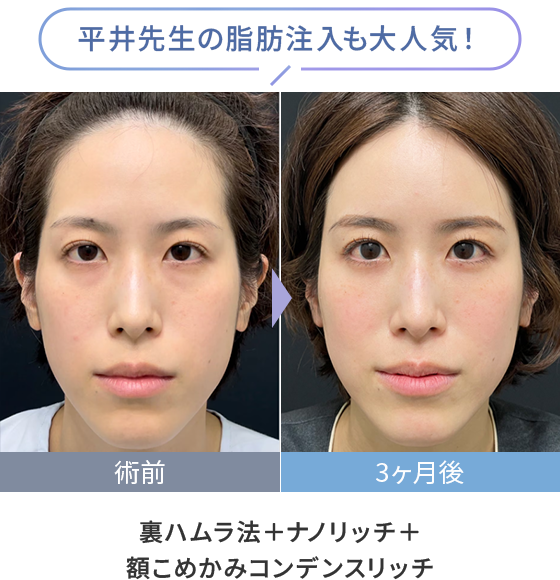 平井先生の脂肪注入も大人気！