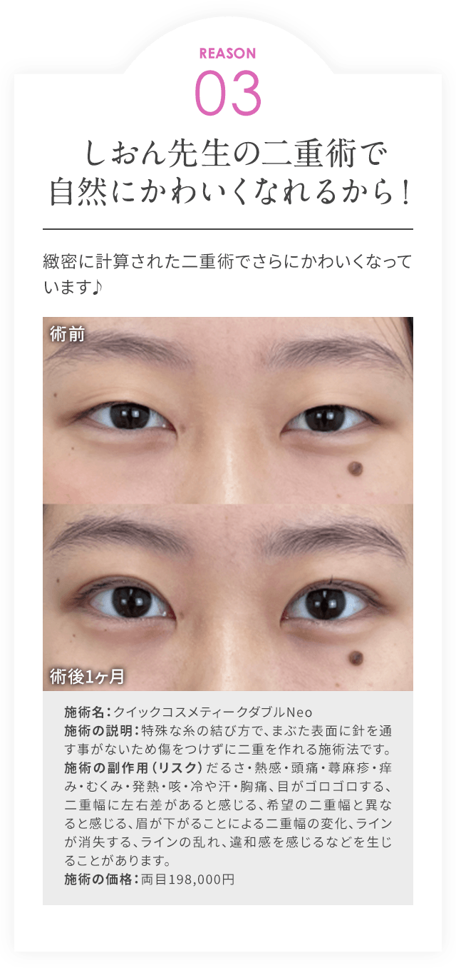 REASON03/しおん先生の二重術で自然にかわいくなれるから！