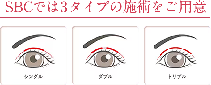 SBCでは3タイプの施術をご用意