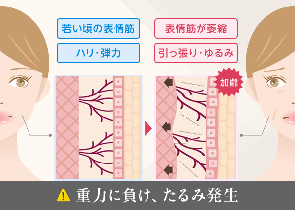 重力に負け、たるみ発生