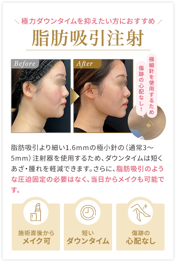 極力ダウンタイムを抑えたい方におすすめ 脂肪吸引注射