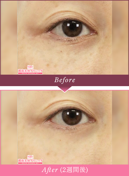 Before Afterの写真