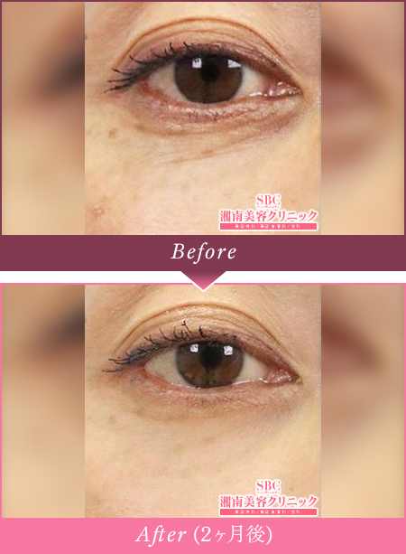 Before Afterの写真