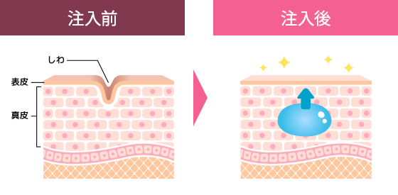 注入前・注入後の図