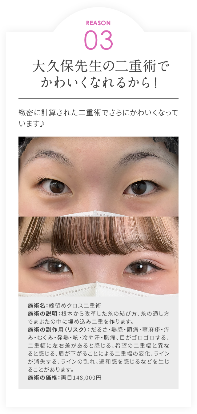 REASON03/大久保先生の二重術でかわいくなれるから！