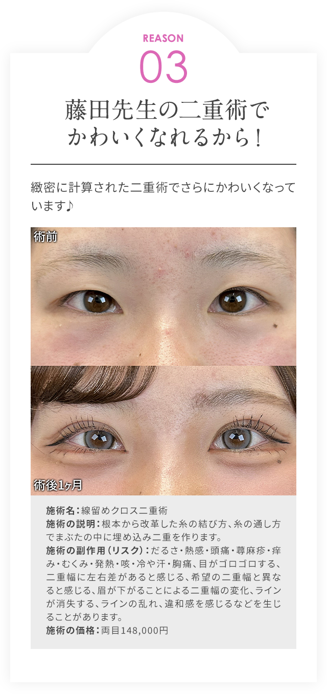 REASON03/藤田先生の二重術でかわいくなれるから！