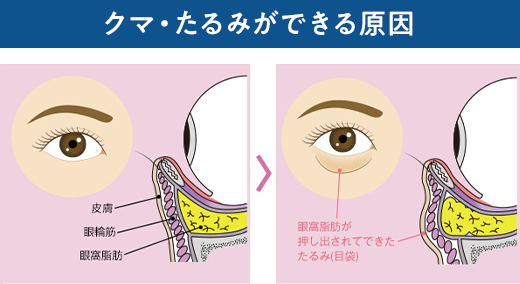 クマ・たるみができる原因