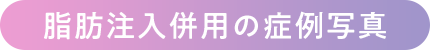 脂肪注入併用の症例写真