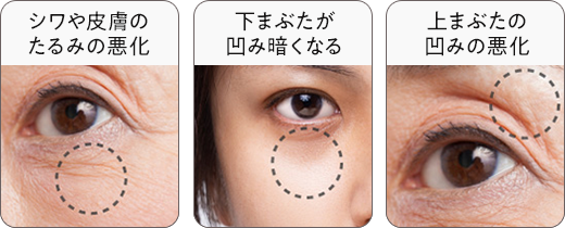 シワ皮膚のたるみの悪化 下まぶたが凹み暗くなる 上まぶたが凹み悪化