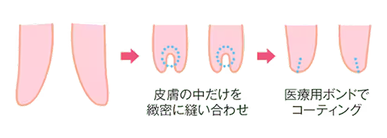 抜糸なし7daysの施術説明図