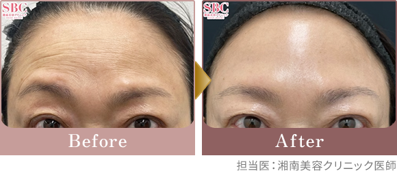 Before After