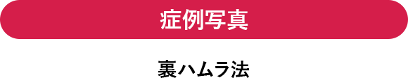脂肪注入併用の症例写真