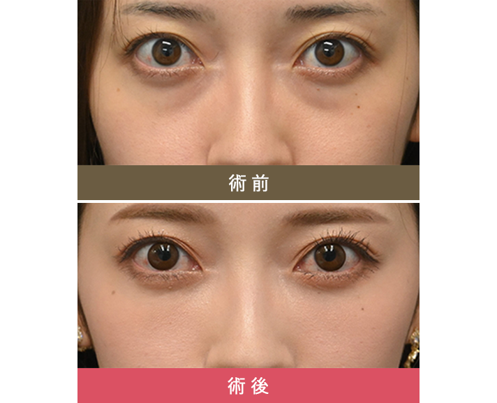 術前