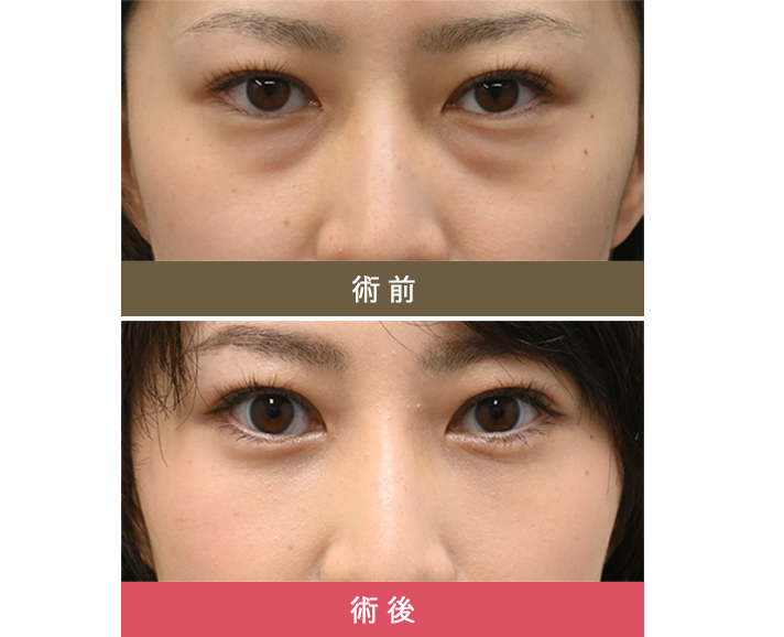 術前