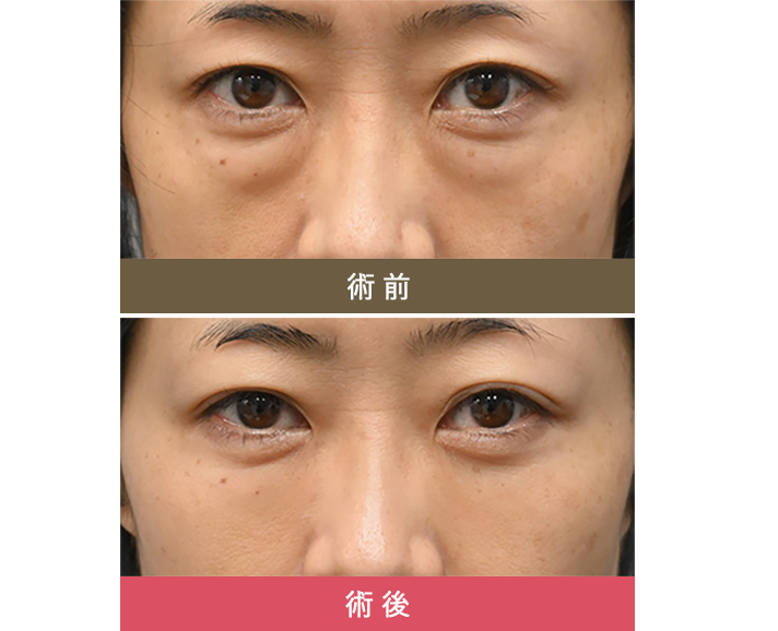 術前