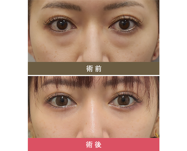術前