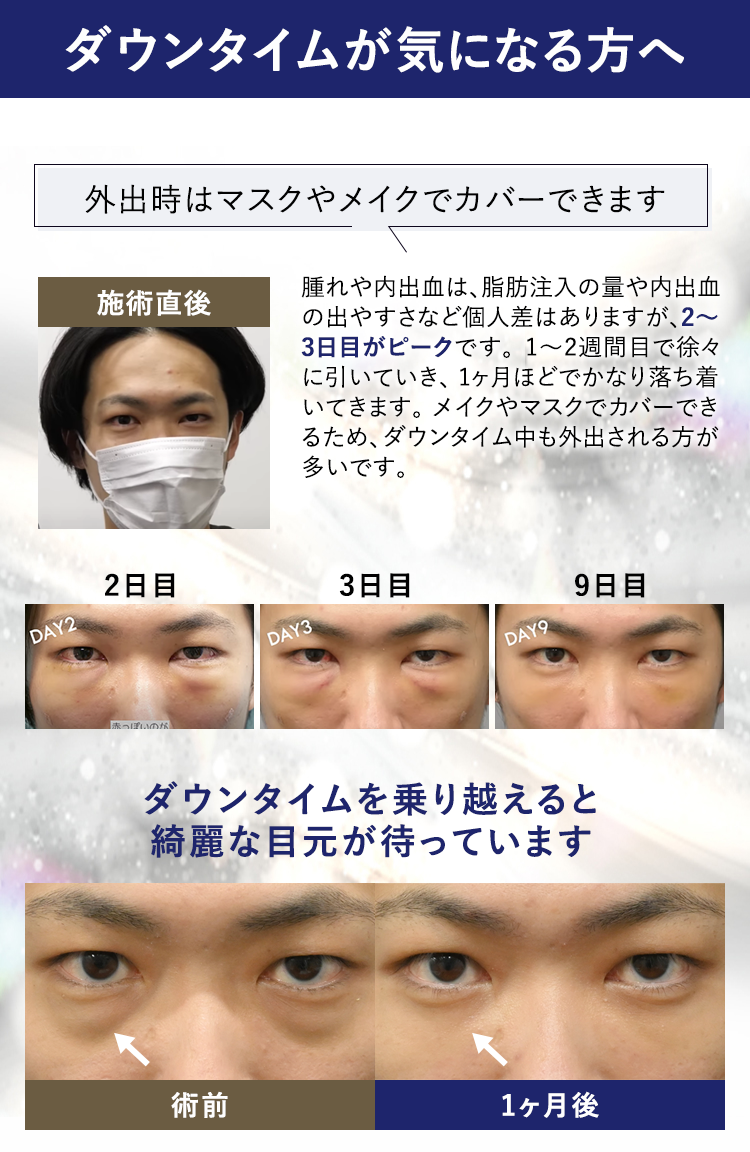 ダウンタイムが気になる方へ