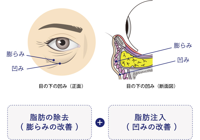 目の下の凹み（正面）目の下の凹み（断面図）脂肪の除去( 膨らみの改善 ) + 脂肪注入( 凹みの改善 )