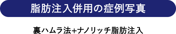 脂肪注入併用の症例写真