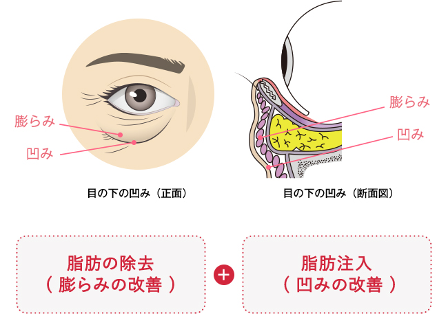 目の下の凹み（正面）目の下の凹み（断面図）脂肪の除去( 膨らみの改善 ) + 脂肪注入( 凹みの改善 )