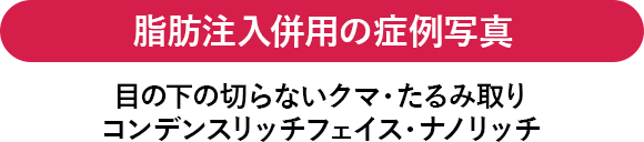 脂肪注入併用の症例写真