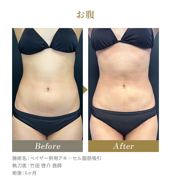 お腹のBeforeAfterの写真|施術名：ベイザー併用アキ―セル脂肪吸引 執刀医：竹田 啓介 医師 術後：6ヶ月