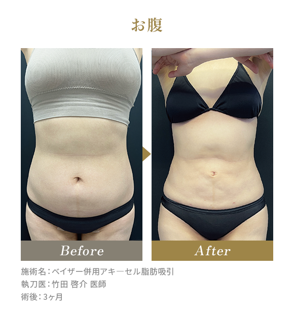 お腹のBeforeAfterの写真|施術名：ベイザー併用アキ―セル脂肪吸引 執刀医：竹田 啓介 医師 術後：3ヶ月