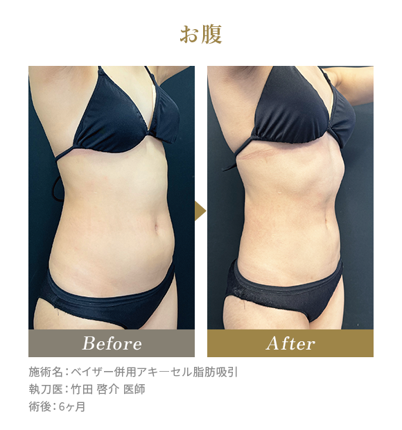 お腹のBeforeAfterの写真|施術名：ベイザー併用アキ―セル脂肪吸引 執刀医：竹田 啓介 医師 術後：6ヶ月