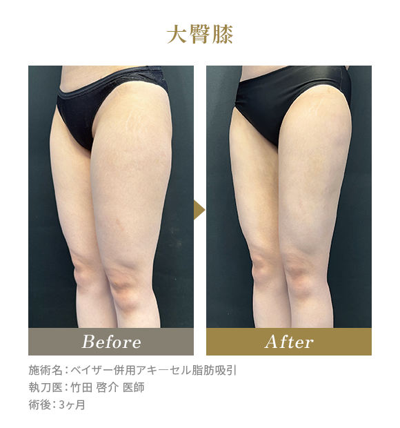大臀膝のBeforeAfterの写真|施術名：ベイザー併用アキ―セル脂肪吸引 執刀医：竹田 啓介 医師 術後：6ヶ月
