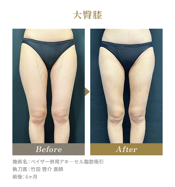 大臀膝のBeforeAfterの写真|施術名：ベイザー併用アキ―セル脂肪吸引 執刀医：竹田 啓介 医師 術後：6ヶ月