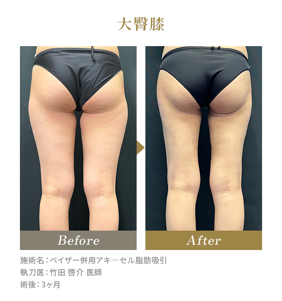 大臀膝のBeforeAfterの写真|施術名：ベイザー併用アキ―セル脂肪吸引 執刀医：竹田 啓介 医師 術後：3ヶ月
