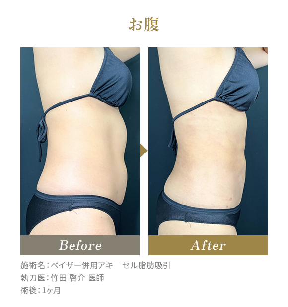 お腹のBeforeAfterの写真|施術名：ベイザー併用アキ―セル脂肪吸引 執刀医：竹田 啓介 医師 術後：1ヶ月