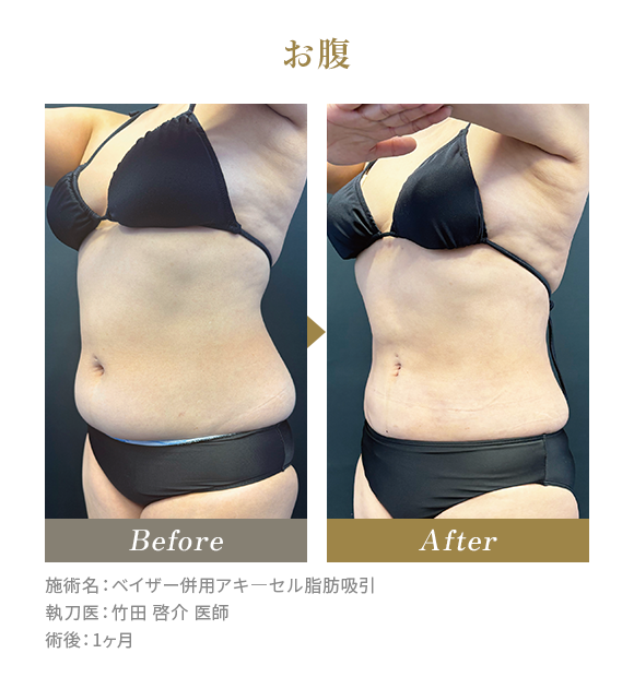 お腹のBeforeAfterの写真|施術名：ベイザー併用アキ―セル脂肪吸引 執刀医：竹田 啓介 医師 術後：1ヶ月