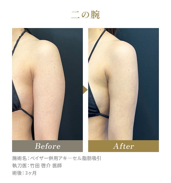 二の腕のBeforeAfterの写真|施術名：ベイザー併用アキ―セル脂肪吸引 執刀医：竹田 啓介 医師 術後：3ヶ月
