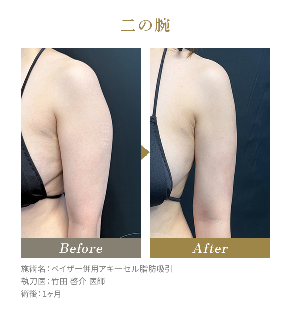 二の腕のBeforeAfterの写真|施術名：ベイザー併用アキ―セル脂肪吸引 執刀医：竹田 啓介 医師 術後：1ヶ月