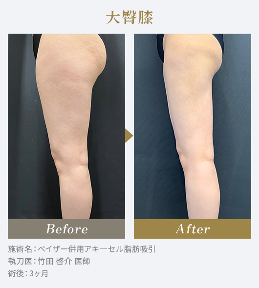 大臀膝のBeforeAfterの写真|施術名：ベイザー併用アキ―セル脂肪吸引 執刀医：竹田 啓介 医師 術後：3ヶ月