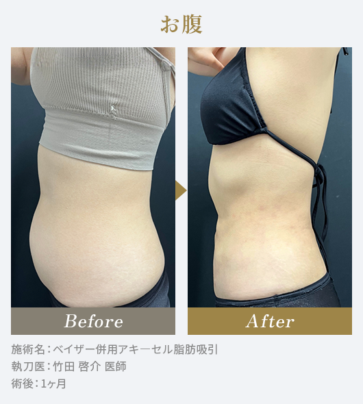 お腹のBeforeAfterの写真|施術名：ベイザー併用アキ―セル脂肪吸引 執刀医：竹田 啓介 医師 術後：1ヶ月