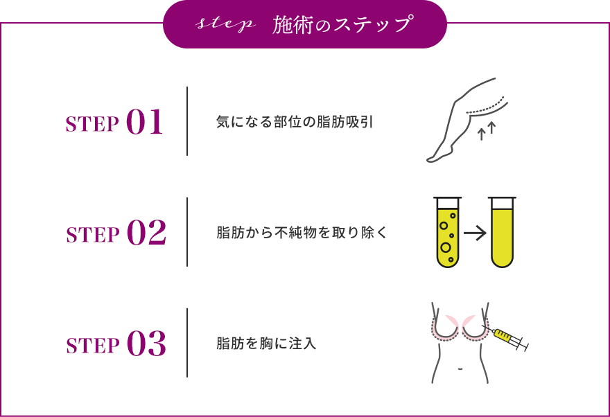 施術のステップ STEP01 気になる部位の脂肪吸引 STEP02 脂肪から不純物を取り除く STEP03 脂肪を胸に注入