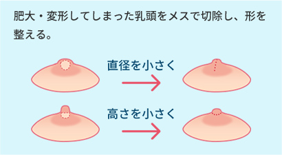 肥大・変形してしまった乳頭をメスで切除し、形を整える。