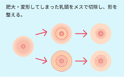 肥大・変形してしまった乳頭をメスで切除し、形を整える。