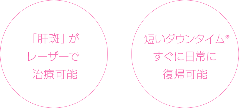 「肝斑」がレーザーで 治療可能短いダウンタイム治療に効果的