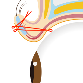 切らない眼瞼下垂 真崎式とは？ 画像3