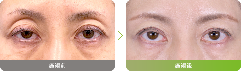 切らない眼瞼下垂　真崎式 Before After