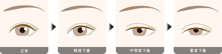 眼瞼下垂とは 流れ1