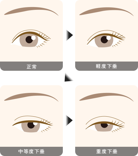 眼瞼下垂とは 流れ2