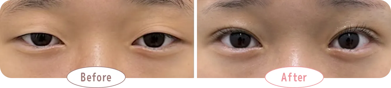 【重いまぶた】眠たそうな目元が、明るく華やかに