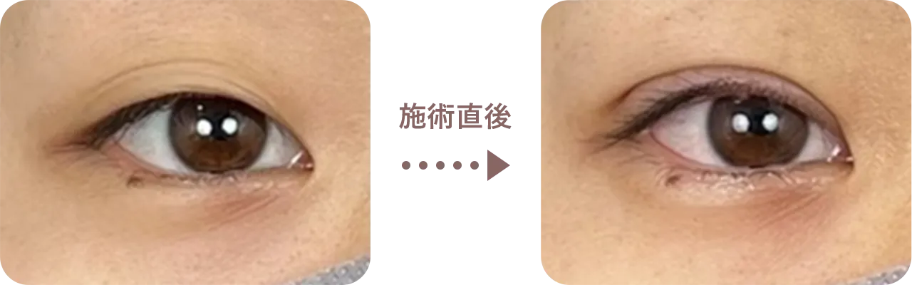 腫れが出にくい